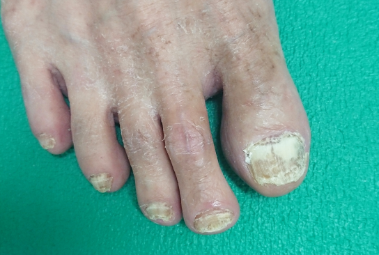 代表的な爪水虫の症状