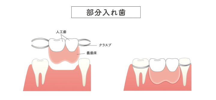 部分入れ歯