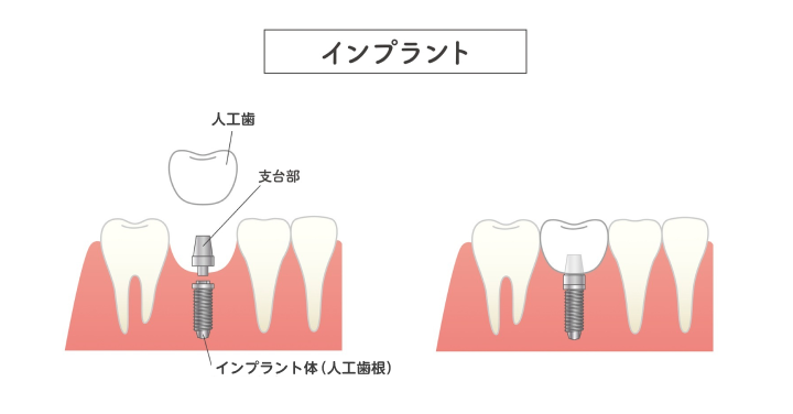 インプラント